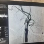 VELMED Hospital, Dehradun में स्ट्रोक से बचाव के लिए जटिल सर्जरी सफल