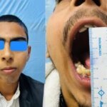 सतत उपलब्धियों का पर्याय बना एम्स, दंत चिकित्सा विभाग ने दिखाया उच्च कौशल, बिना कृत्रिम जोड़ के जन्मजात चेहरे की विकृति का सफल सुधार